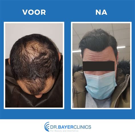 Haartransplantatie Voor En Na: Hoe Te Effectiveren?