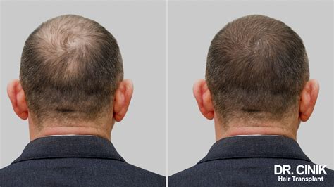 De Eerste Stappen Na Een Haartransplantatie