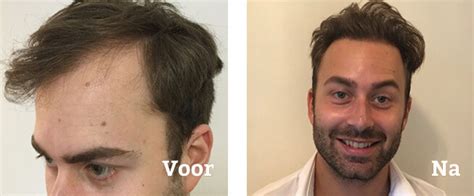 Haartransplantatie Kosten: Wat Mag Je Verwachten?