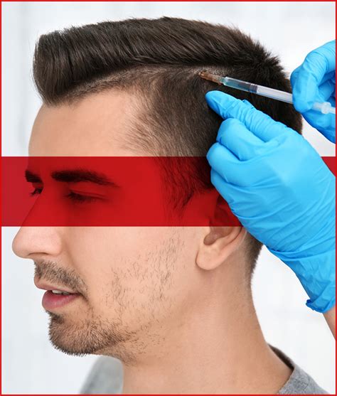 De Rol Van PRP Behandeling Bij Haartransplantatie