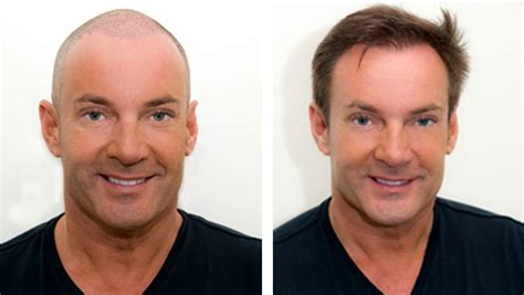 Haartransplantatie En Gender: Verschillen In Aanpak