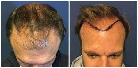 Haartransplantatie Voor Jongere Klanten: Wat Moet Je Weten?