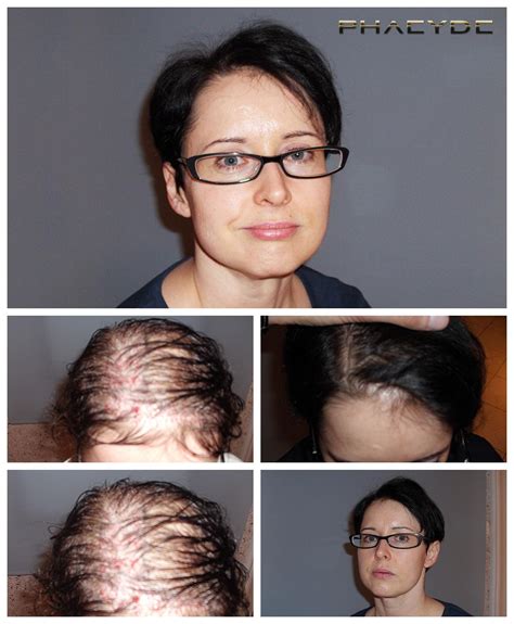 Haartransplantatie Voor Vrouwen: Wat Zijn De Specifieke Overwegingen?