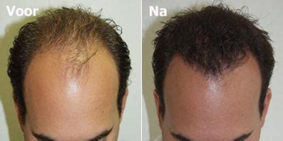 Verschillende Soorten Haartransplantatie: Wat Is Geschikt Voor Jou?
