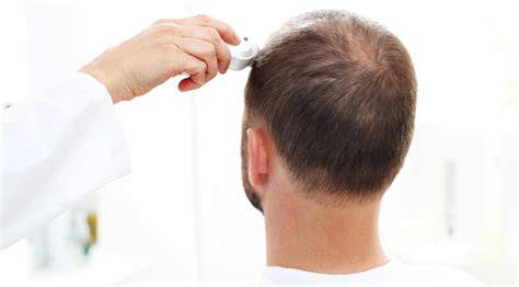 Waarom Kiezen Voor Een Haartransplantatie In Turkije?