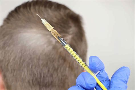 De Meest Veelvoorkomende Misverstanden Over Haartransplantaties