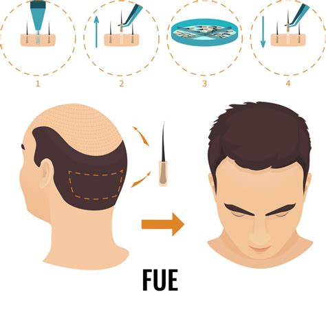 De Verschillen Tussen DHI En FUE Haartransplantaties