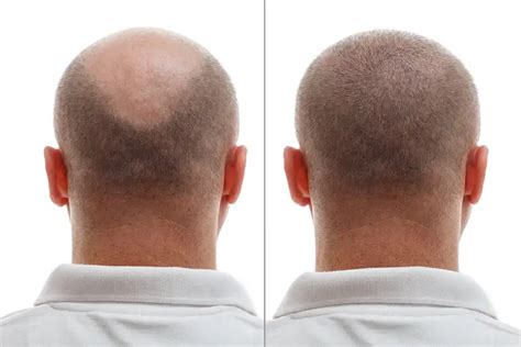 De Voordelen Van Haartransplantatie DHI Technieken