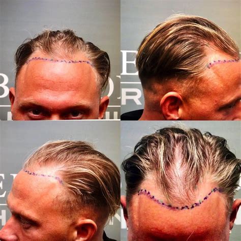 Haartransplantatie En De Rol Van Technologie