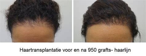 Haartransplantatie Voor En Na: Inspirerende Succesverhalen