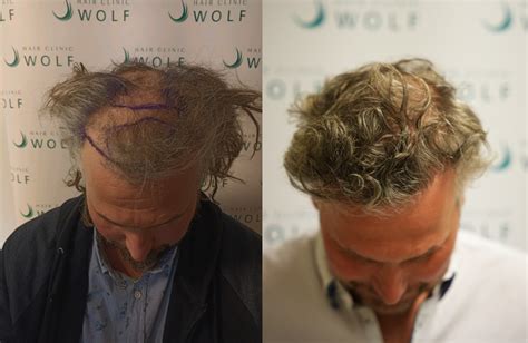 Haartransplantatie: Wat Je Moet Weten Voor Je Begin