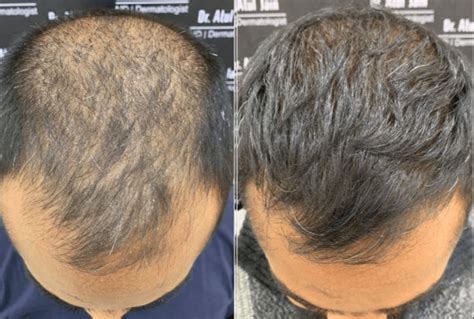 Haartransplantatie: Wat Je Voor De Behandeling Moet Weten