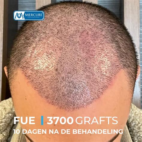 Saffier FUE: Een Nieuwe Doorbraak In Haartransplantatie