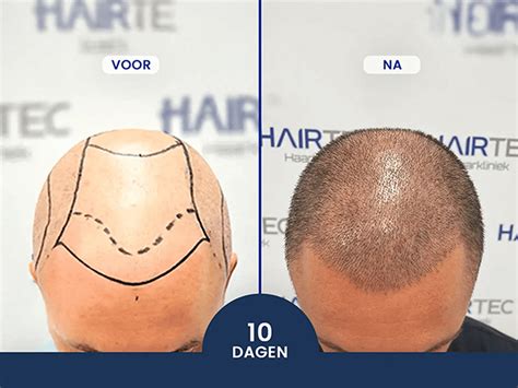 Waarom Haartransplantatie Een Steeds Populairste Keuze Wordt